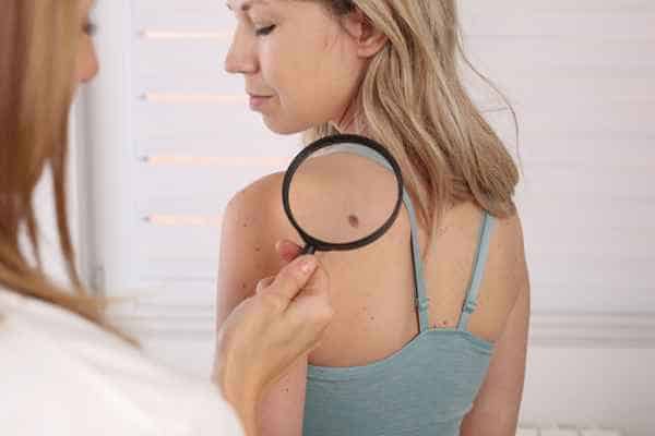 What Are Traditional Skin Lesion Removal Methods Ellesmere Port?
