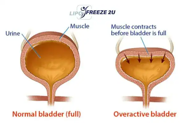 diagram of overactive bladder treatment Ellesmere Port
