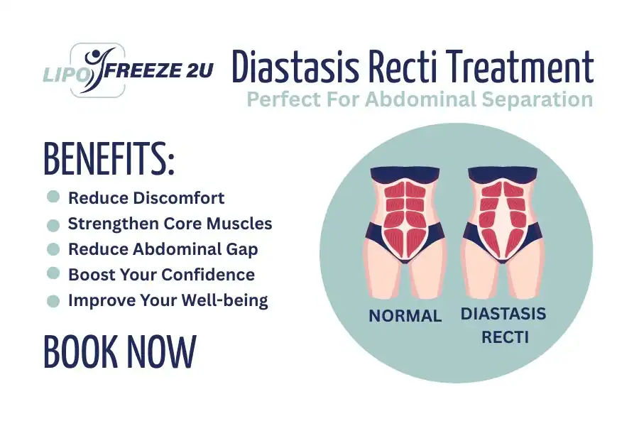 How Long Will It Take to See Improvements in Diastasis Recti Ellesmere Port