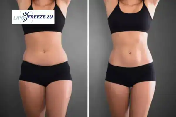 How Can LIPO FREEZE 2U Support Your Post-Pregnancy Body Recovery Ellesmere Port?