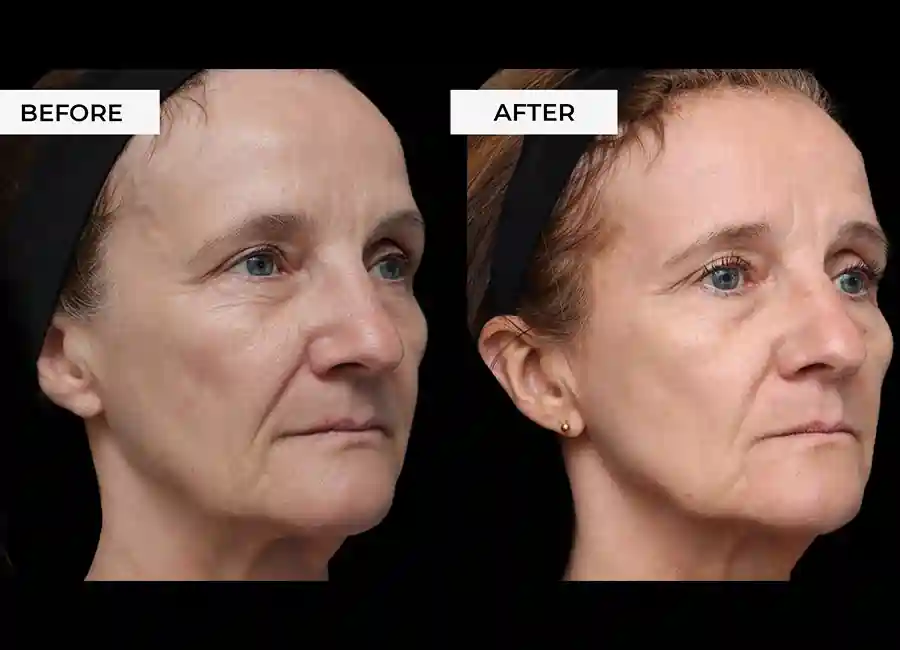 How Many RF Microneedling Sessions Will You Need to See a Difference Ellesmere Port?