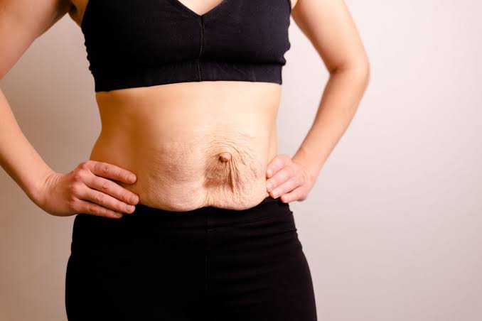 Is Surgery Really the Only Way to Repair Diastasis Recti Ellesmere Port?