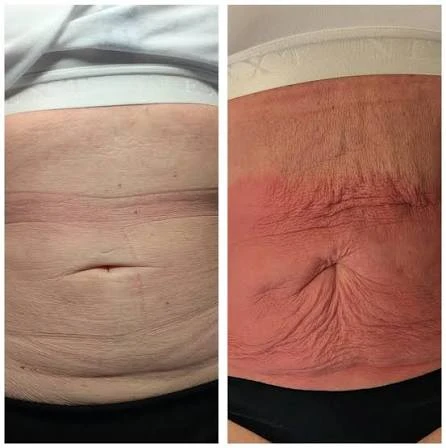 How Does RF Microneedling Improve Crepey, Thin and Uneven Skin Texture Ellesmere Port?