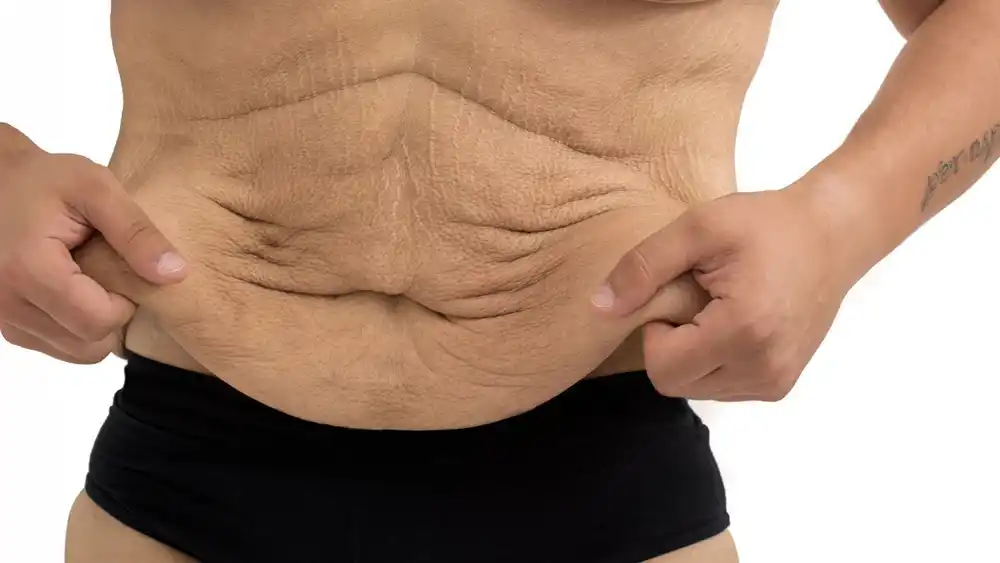 RF Microneedling for Loose Skin: How Can It Help Tighten and Reshape the Skin Ellesmere Port?